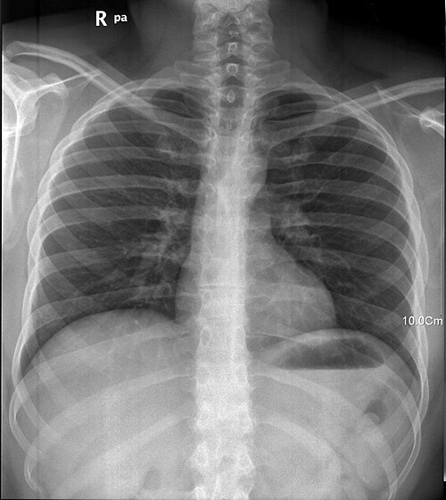 CXR