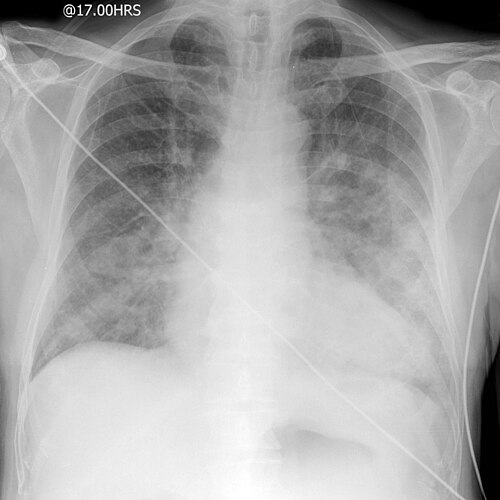 Portable CXR