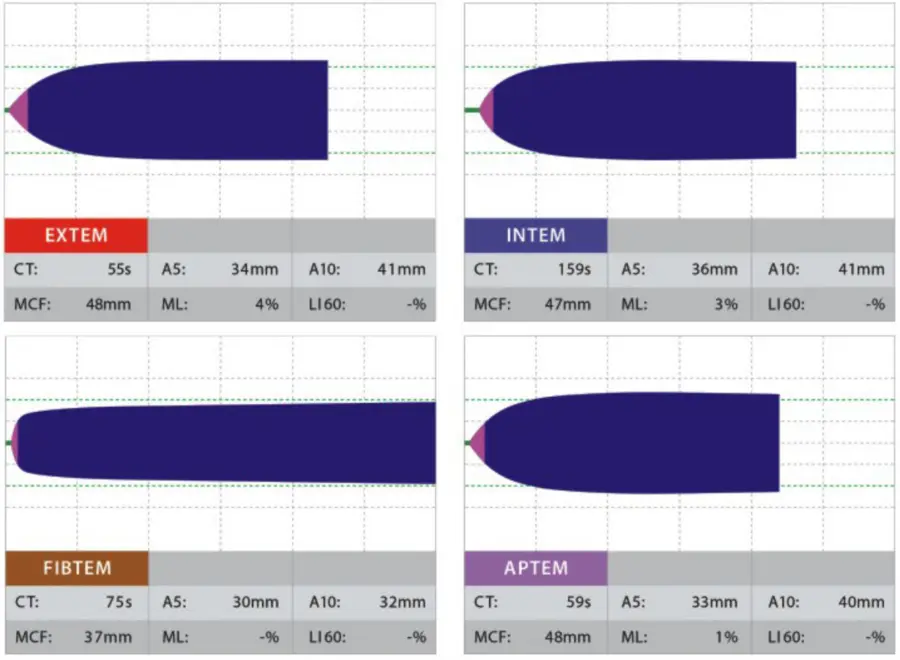 ROTEM Clinical Trace High Fibrin Contribution
