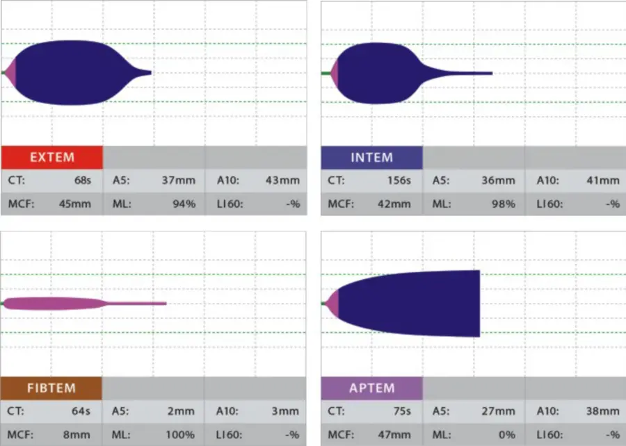 ROTEM Clinical Trace Hyperfibrinolysis