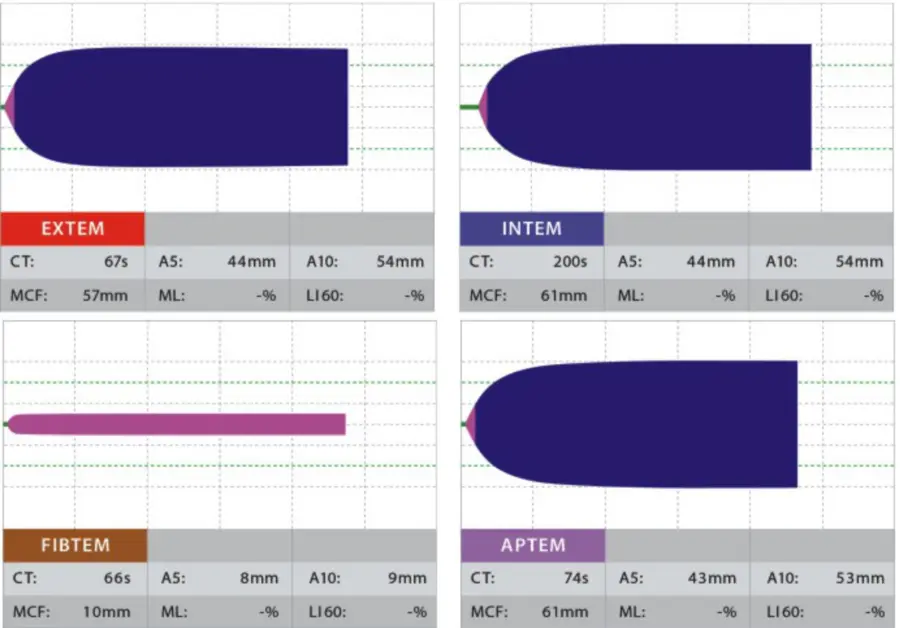 ROTEM Clinical Trace Normal Profile